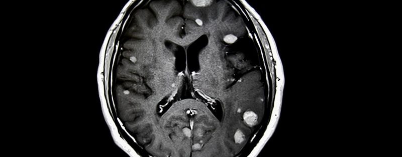 Preoperative Radiosurgery for Brain Metastases Shows Promise