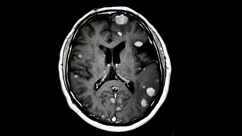 Preoperative Radiosurgery for Brain Metastases Shows Promise