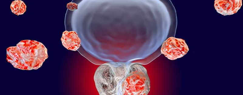 PSMA-PET Challenges Current Prostate Cancer Staging