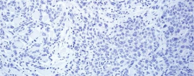 T-DM1 Boosts Survival in HER2-Positive Breast Cancer