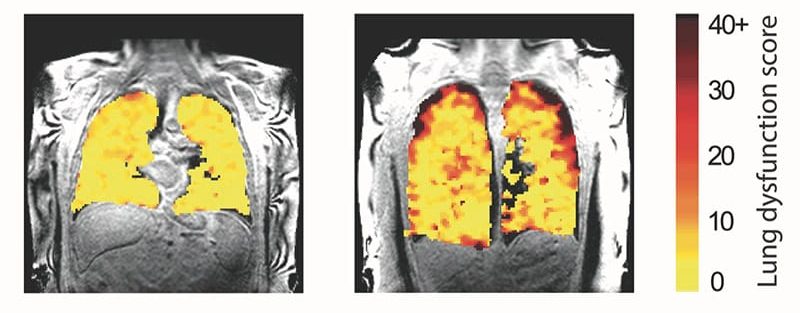 Lung MRI Using Inhaled Can Detect Damage