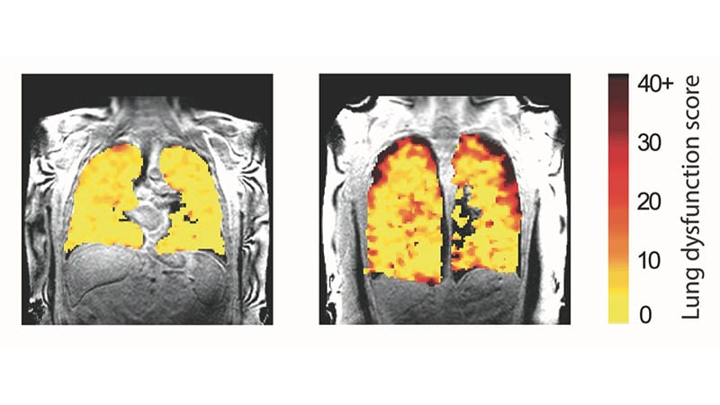 Lung MRI Using Inhaled Can Detect Damage