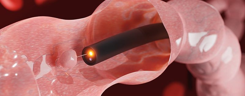 Fecal Hemoglobin Levels From Negative FITs Signal CRC Risk