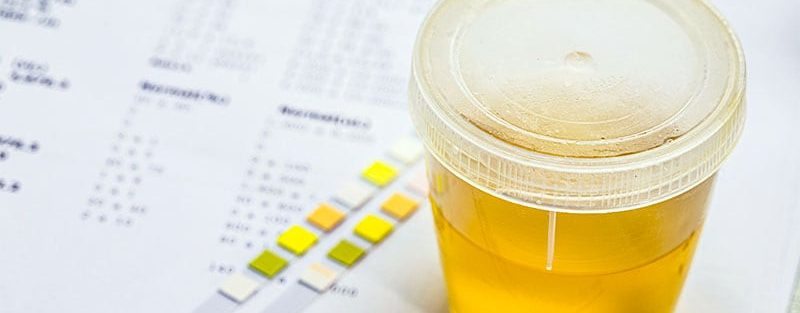 Urine-based Test Shows Promise in Detecting Bladder Cancer