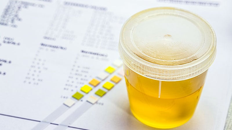 Urine-based Test Shows Promise in Detecting Bladder Cancer