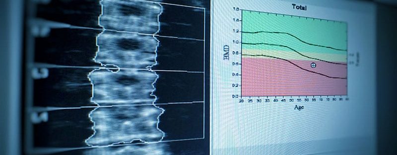 Romosozumab Improves Bone Strength in Women With T2D