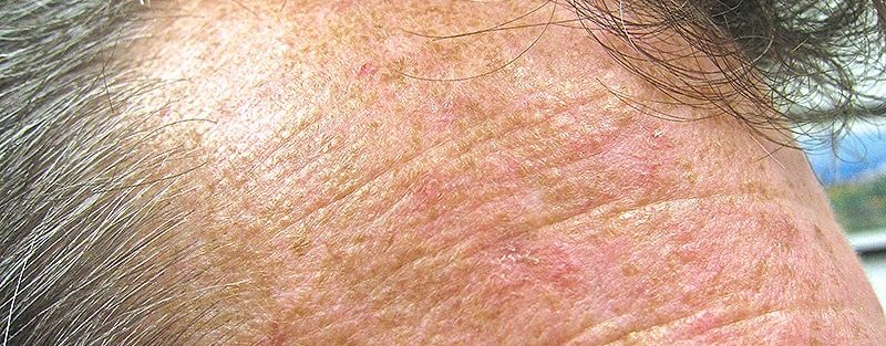 Transplant Recipients Face High Risk for Actinic Keratosis