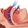 Sleep apnea linked to increased risk of Parkinson’s: Study suggests CPAP may reduce risk