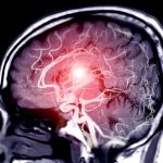 No Benefit of EVT in Medium-Vessel Occlusion Stroke