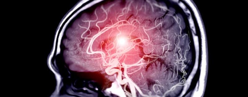 No Benefit of EVT in Medium-Vessel Occlusion Stroke